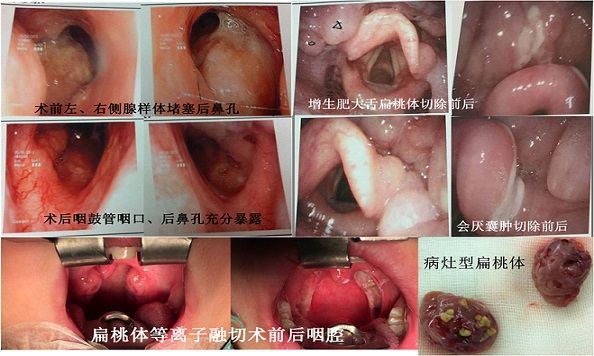 等离子2.jpg